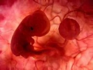 Sonhos com São Tomás de Aquino mudam a conduta de médico abortista da antiga Iugoslávia